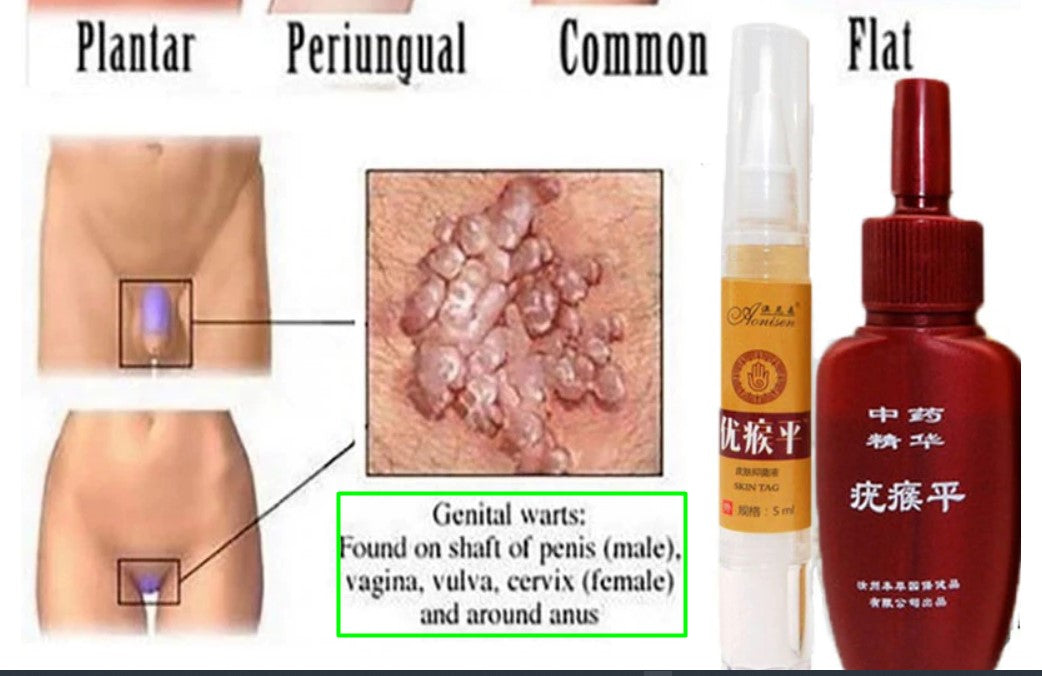 Umhlume Treatment - Moles & Genital Warts/Papillomas & Foot Corns Remover